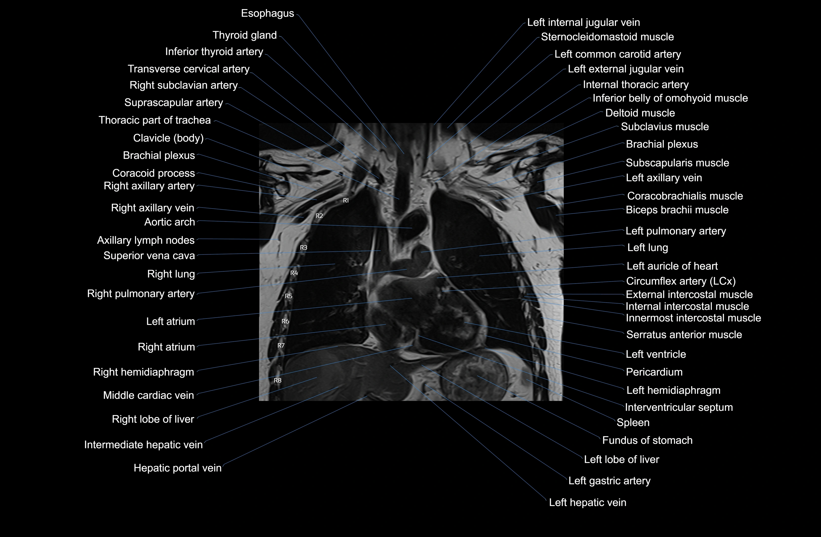 MRI chest (thorax) coronal  cross sectional anatomy 3T radiology  image-img-00001-00019.webp